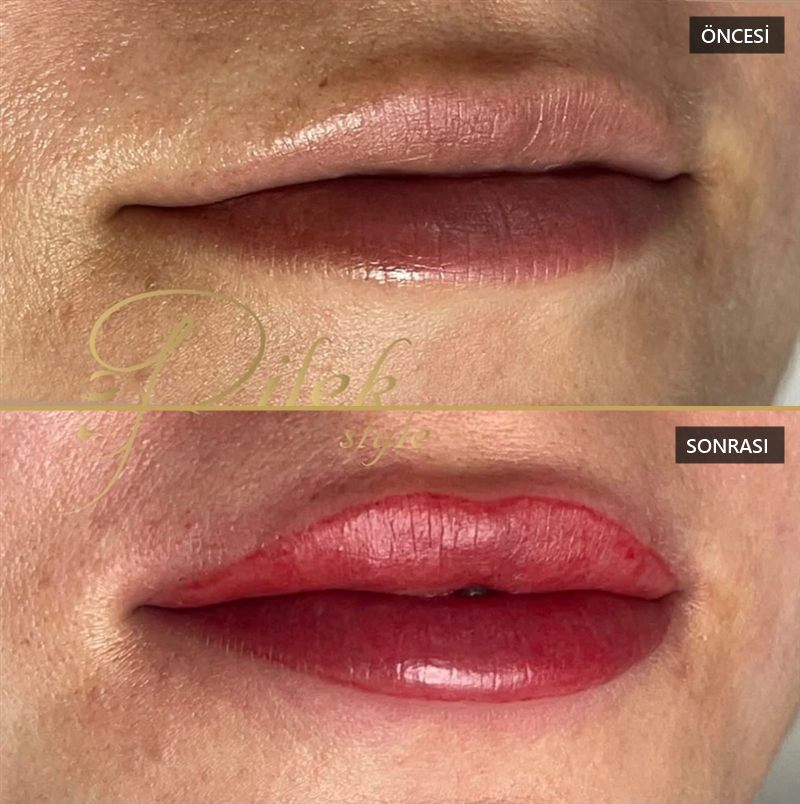 Dudak renklendirme öncesi ve sonrası — müşteri 1